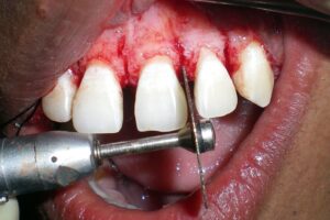 Corticotomy to increase the speed of tooth movement