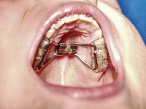 Narrowness of the upper jaw arch using an expander or RME