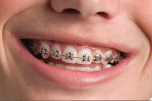Phase 1 orthodontics and ideal bite