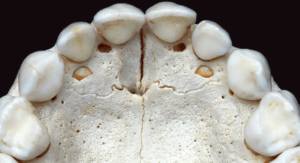 Premaxillary bone or perimaxilla