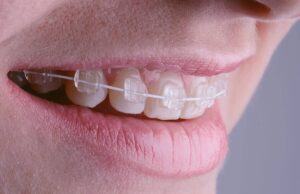 Transparent braces orthodontic treatment
