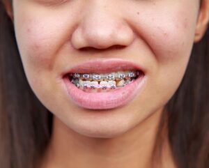 Treatment of underbite by means of orthodontics